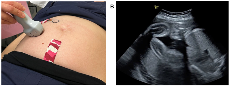Новый носимый патч для непрерывного мониторинга движений плода