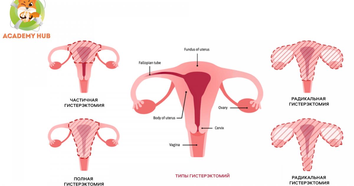 Ассоциированные с ВПЧ цервикальные интраэпителиальные неоплазии высокой ...