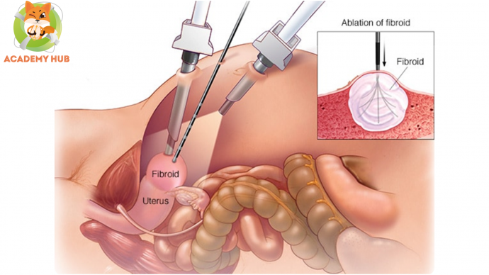 Комбинированная трансабдоминальная и трансвагинальная чрескожная микроволновая аблация миомы матки под УЗ-контролем