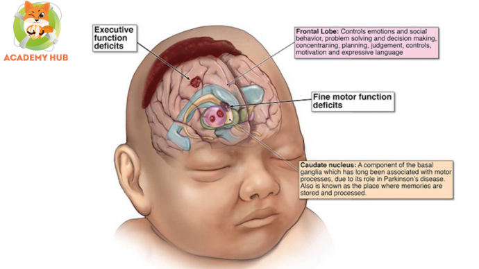 Материнские и фетальные факторы риска неонатальной гипоксическо-ишемической энцефалопатии: ретроспективное исследование