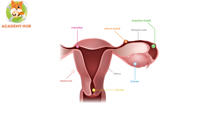 Новая клиническая классификация внематочной беременности в рубце после кесарева сечения, рекомендуемая хирургическая тактика