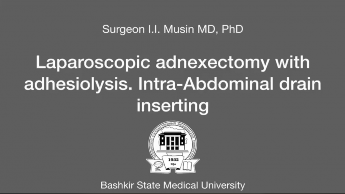 Surgeon I.I. Musin MD, PhD - Laparoscopic adnexectomy with adhesiolysis. Intra-Abdominal drain inserting