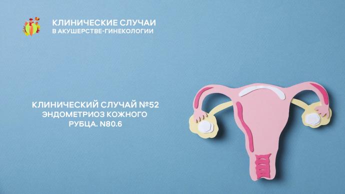 Клинический случай №52. Эндометриоз кожного рубца. N80.6