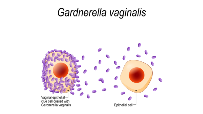 Незамеченная причина рецидивов бактериального вагиноза