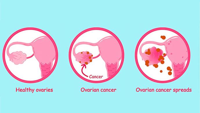 Микробиом как фактор развития рака яичников