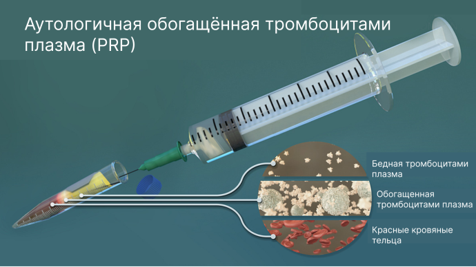 Без рекламы! Применение аутологичной обогащённой тромбоцитами плазмы (PRP) при синдроме поликистозных яичников (СПКЯ) с учётом самых новых данных