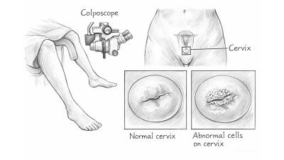 Что нового в кольпоскопии в 2025-2026? Не реклама