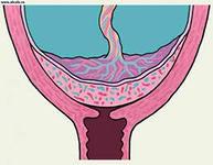 Клинический анализ эмболизации артерии матки при лечении предлежания плаценты