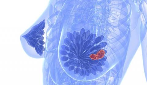 Гормонотерапия в менопаузе и риск рака молочной железы
