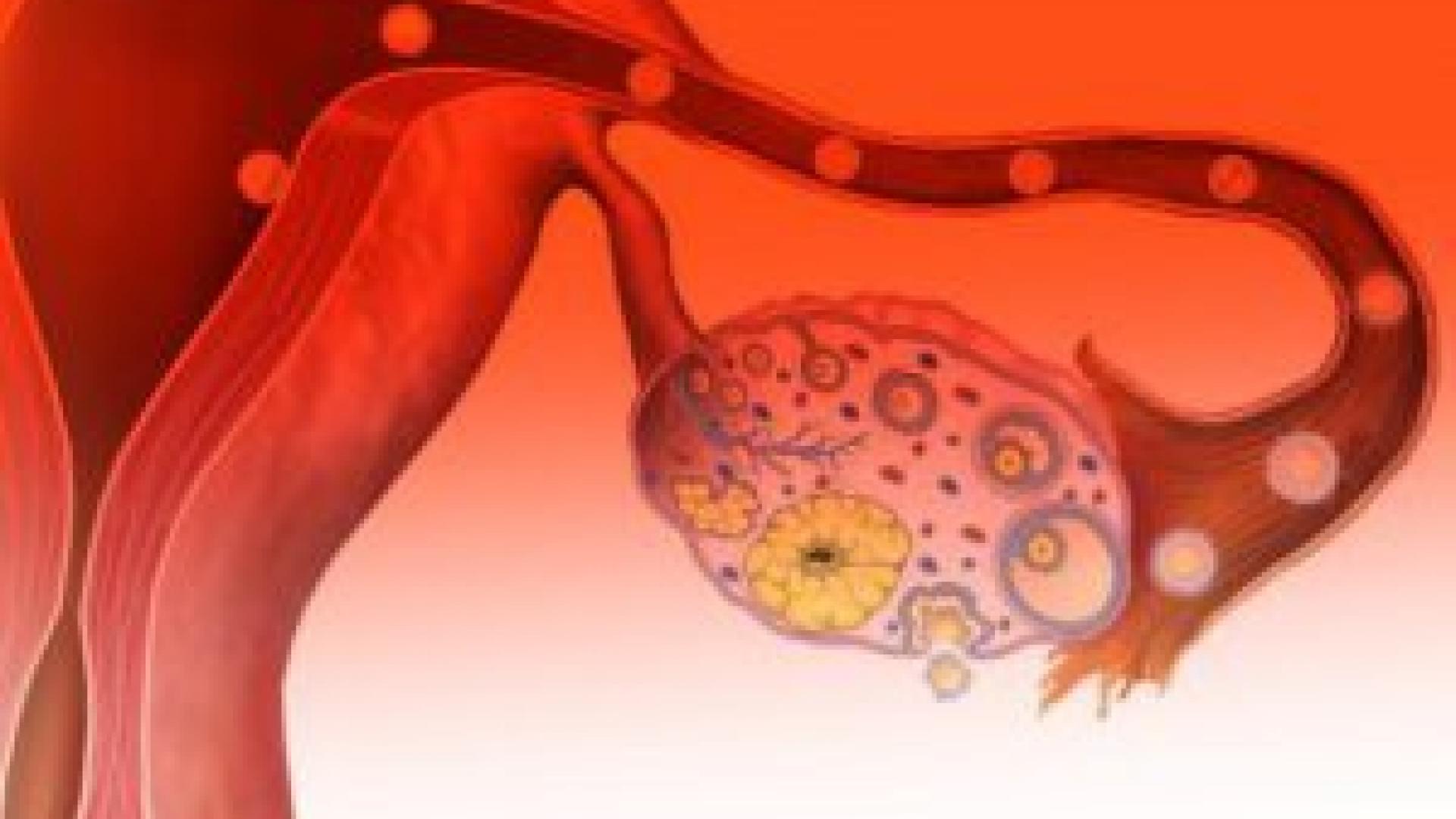 Менопаузы раку яичников раку. Малигнизированная опухоль яичника. Злокачественные новообразования яичников. Злокачественное новообразование яичника. Злокачественные образования яич.