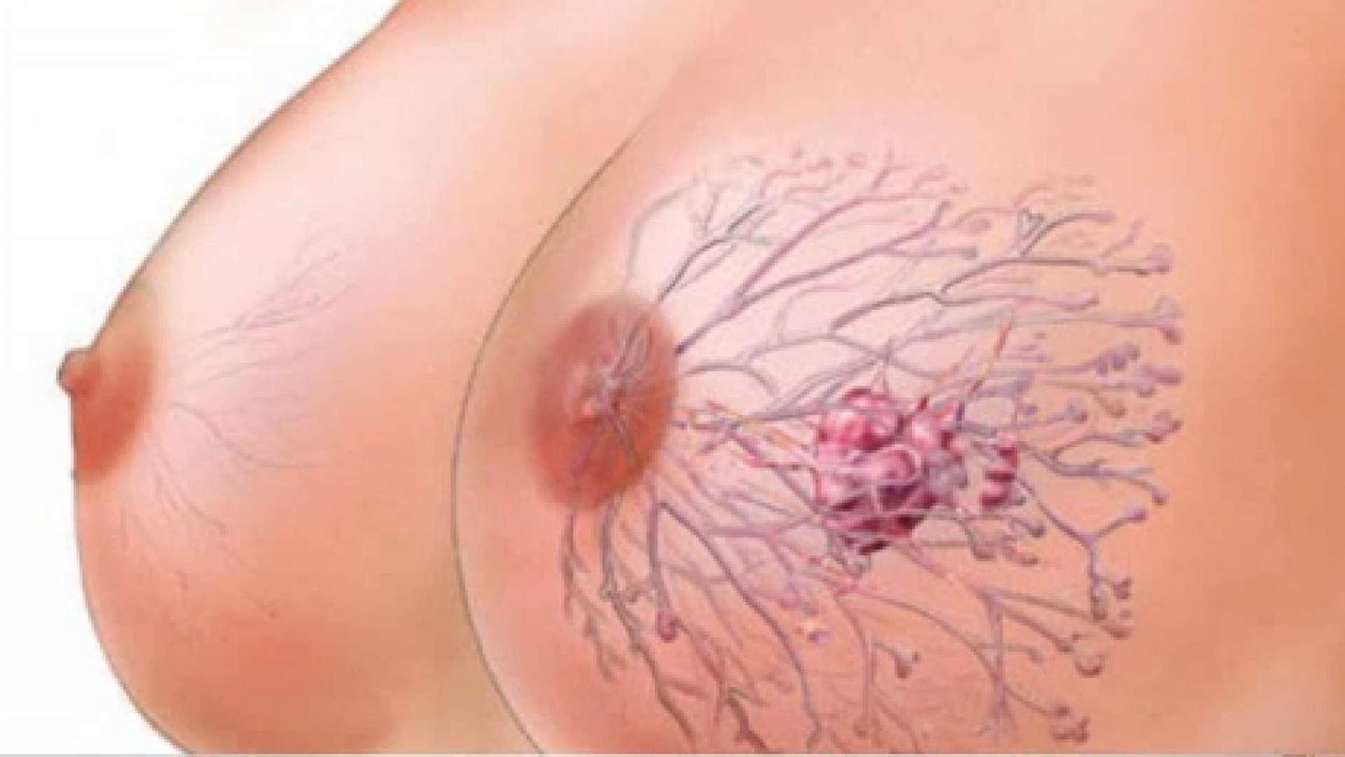 доброкачественные опухоли в груди у женщин фото 21